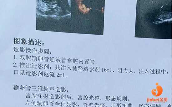 广州皇家试管是真的吗_试管婴儿取精前两周发烧_检查出卵巢囊肿，需要手术吗